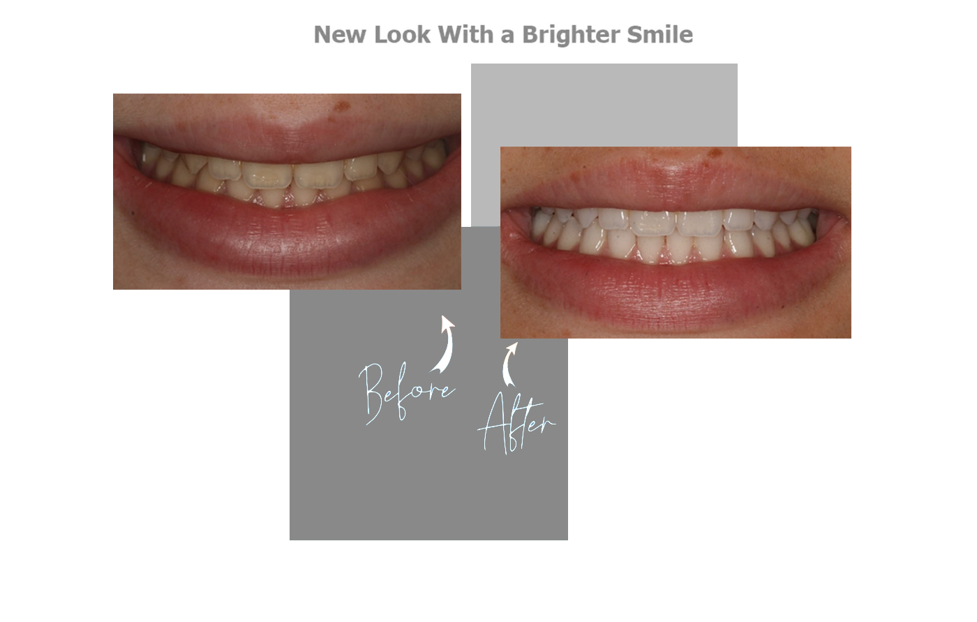 before and after image of teeth transformation